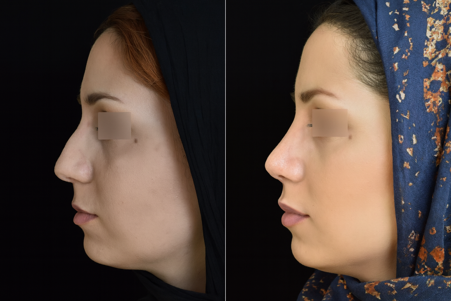 عملية تجميل الأنف في إيران